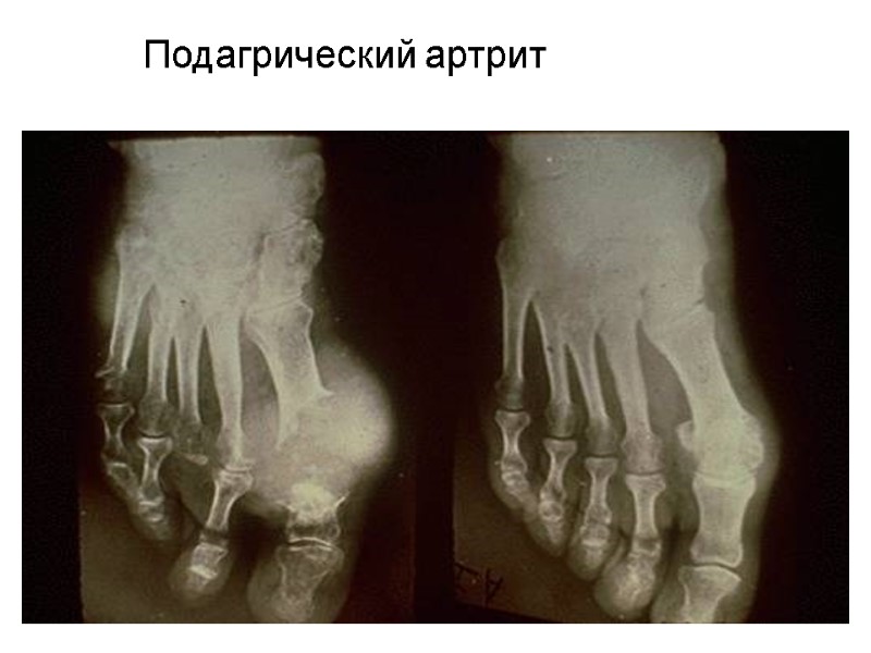 Подагрический артрит